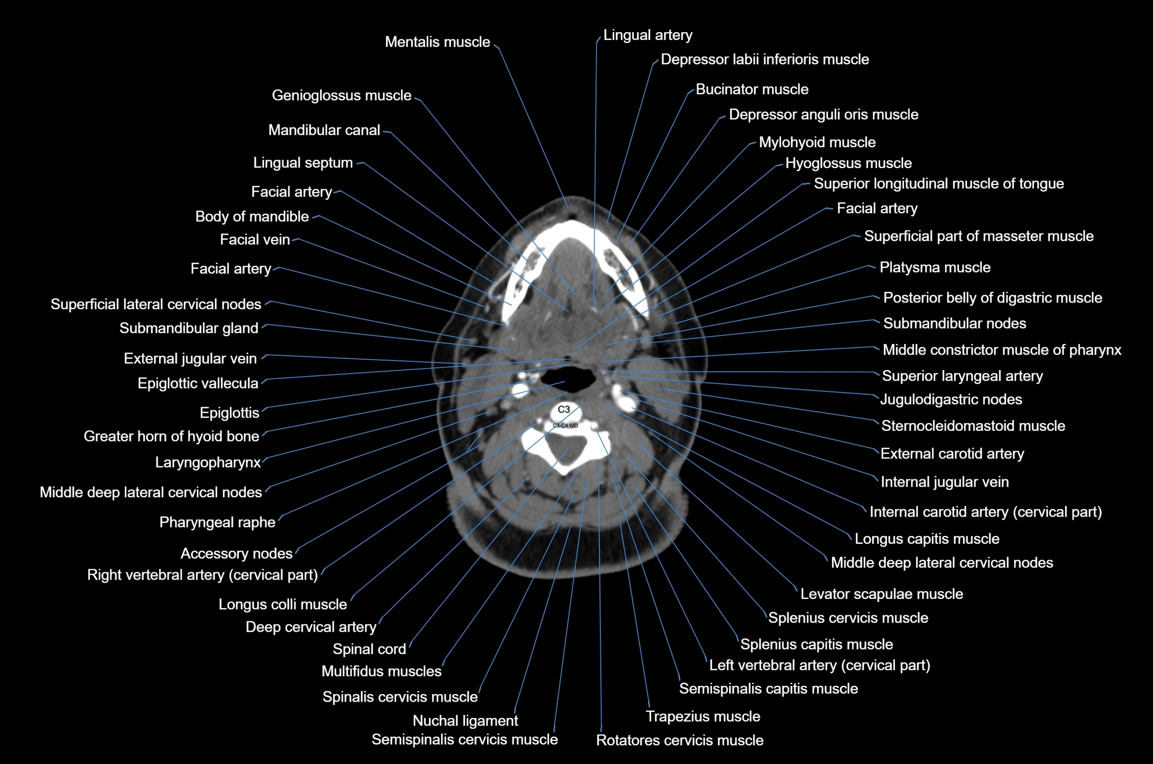 CT Neck axial cross sectional anatomy radiology image-img-00001-00035.webp